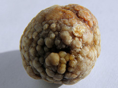 A gallstone, photo by Keith Roper, CC-BY 2012